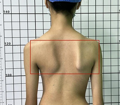Evaluación integral de la escoliosis: comprensión, identificación y tratamiento de la salud de la...