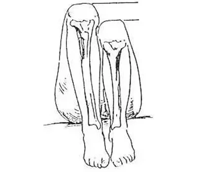 Evaluación de discrepancia en la longitud de las piernas (LLD): una guía práctica para aplicacion...