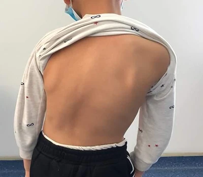 Detección y tratamiento de la escoliosis: cómo el escáner corporal 3D Xianku ayuda a los quiroprá...