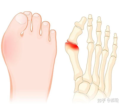 Hallux Valgus: una guía científica completa