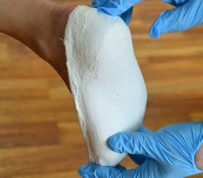 ¿Cómo transformarán los escáneres de pie 3D el futuro de los dispositivos de soporte ortopédico?