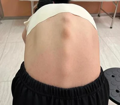 Revolucionando la salud de la columna: escáner corporal 3D Xianku