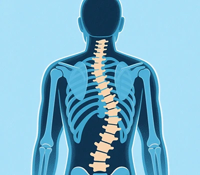 Escoliosis: escáner del cuerpo 3D Xianku, 3D+AI, Prevención y Corrección de Escoliosis