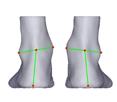 Heel Valgus y Varus: una amenaza silenciosa entre
