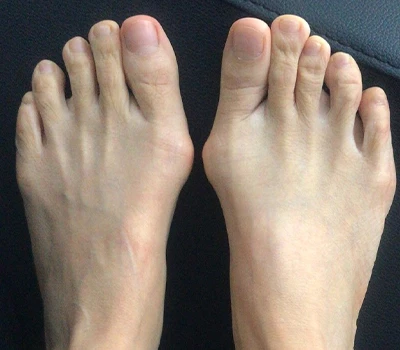 La Medición de Valgus de Hallux: por qué los escáneres 3D están superando a los médicos y hospitales