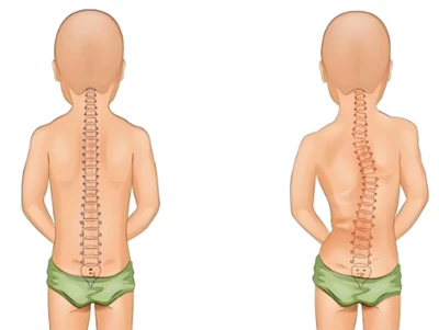 Nuevo método de detección de escoliosis: IA y columna digital 3D