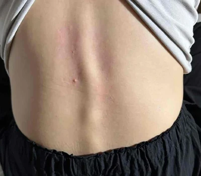 Análisis integral de la escoliosis: comprensión de la afección e innovaciones tecnológicas en eva...
